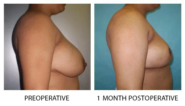 Breast Reduction (Mammoplasty) patient result 15