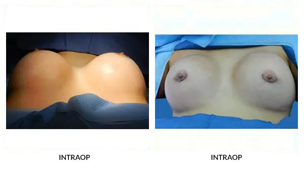 Breast Augmentation patient result 15