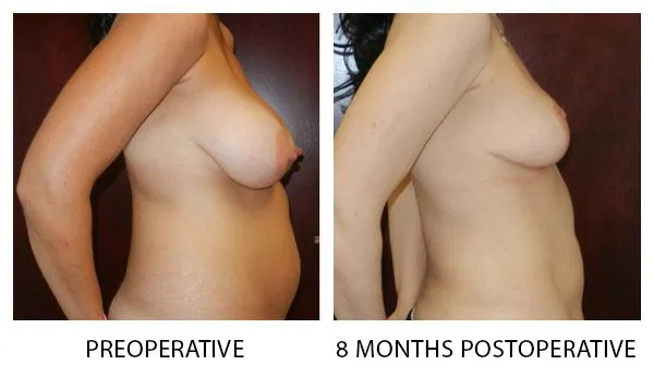 Breast Reduction (Mammoplasty) patient result 7