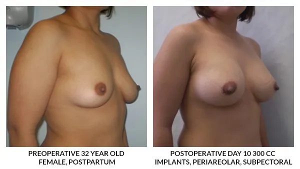 Breast Augmentation patient result 5
