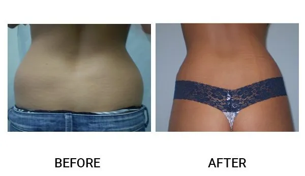 Liposuction patient result 4