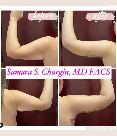 Liposuction patient result 3