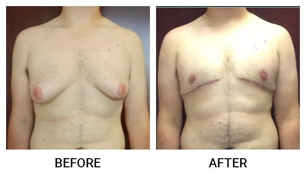 Gynecomastia patient result 1