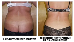 Tummy Tuck (Abdominoplasty) patient result 9