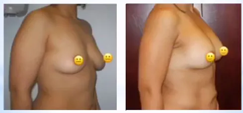 Breast Augmentation patient result 20