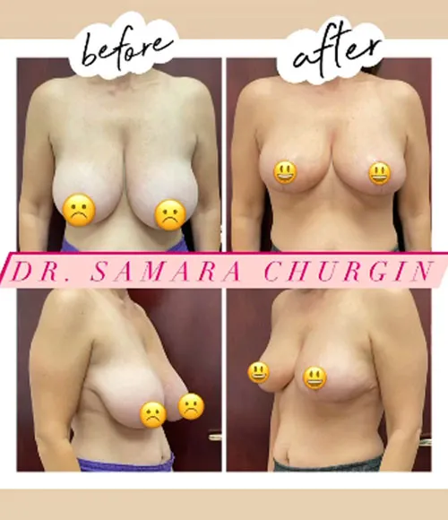 Breast Reduction (Mammoplasty) patient result 26