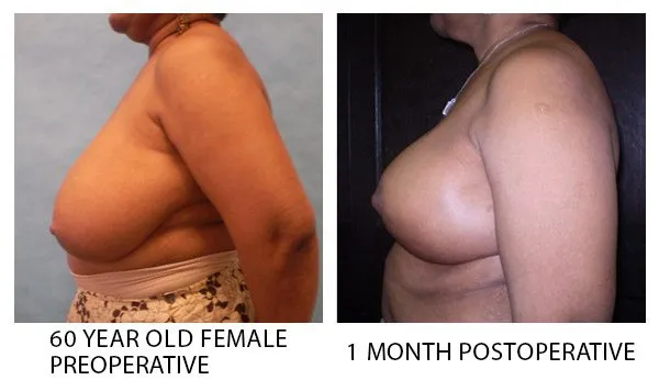 Breast Reduction (Mammoplasty) patient result 5
