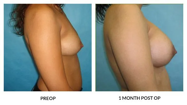 Breast Augmentation patient result 23