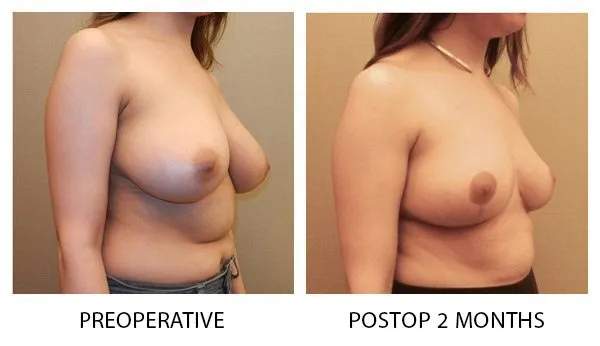 Breast Reduction (Mammoplasty) patient result 17