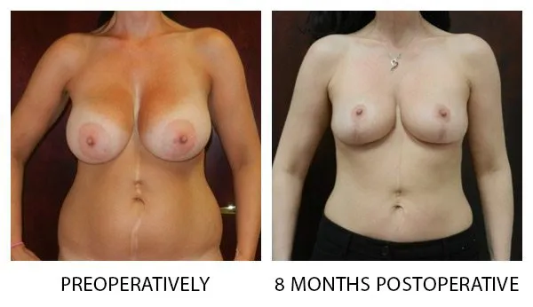 Breast Reduction (Mammoplasty) patient result 6