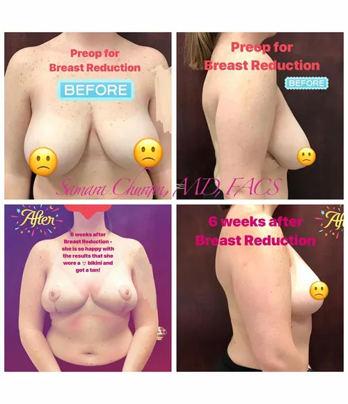 Breast Reduction (Mammoplasty) patient result 25