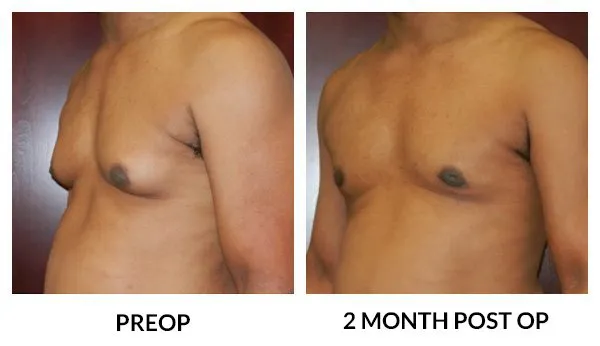 Gynecomastia patient result 6