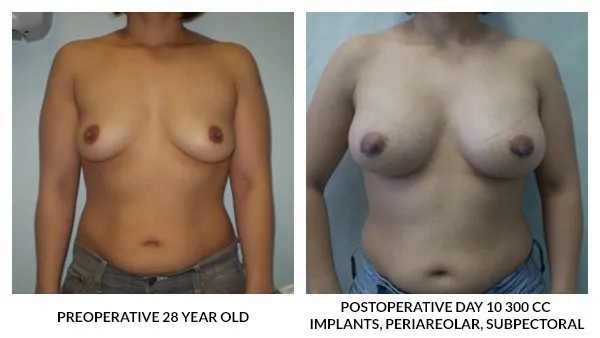 Breast Augmentation patient result 3