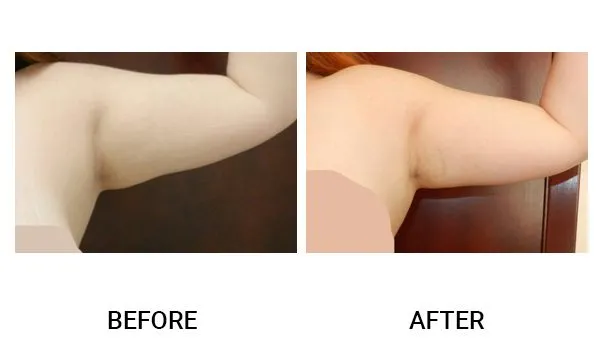 Liposuction patient result 1