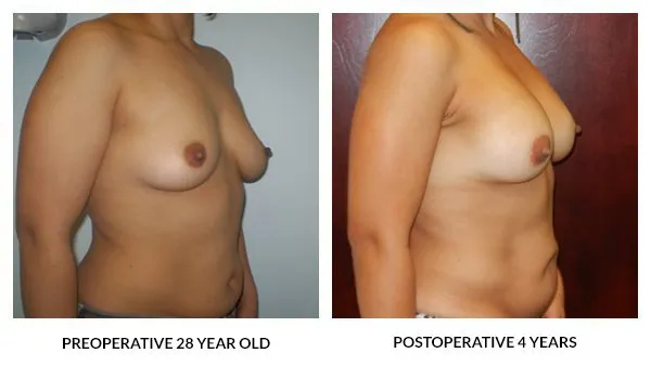 Breast Augmentation patient result 6
