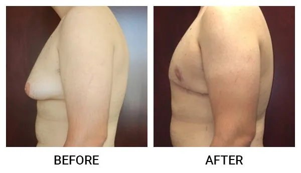 Gynecomastia patient result 2