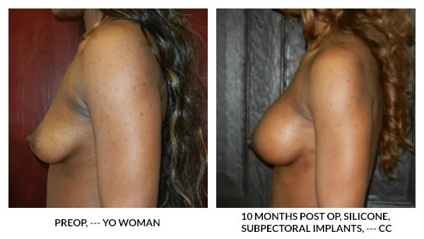 Breast Augmentation patient result 18