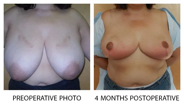 Breast Reduction (Mammoplasty) patient result 12