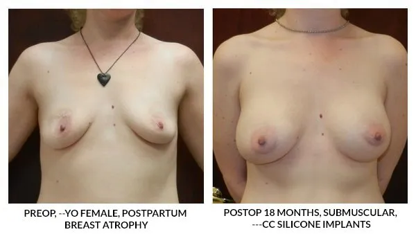 Breast Augmentation patient result 11