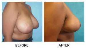 Breast Reduction (Mammoplasty) patient result 2