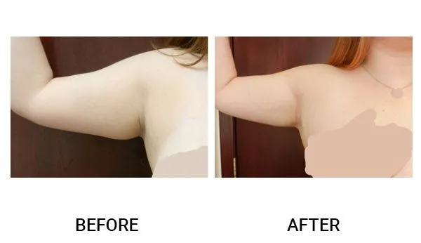 Liposuction patient result 2