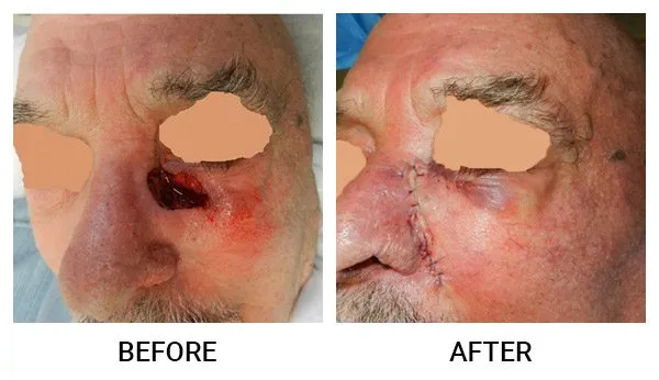 Mohs Reconstruction patient result 6