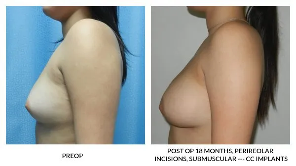 Breast Augmentation patient result 17
