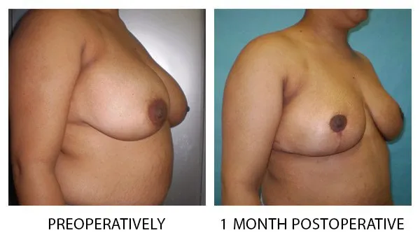 Breast Reduction (Mammoplasty) patient result 11