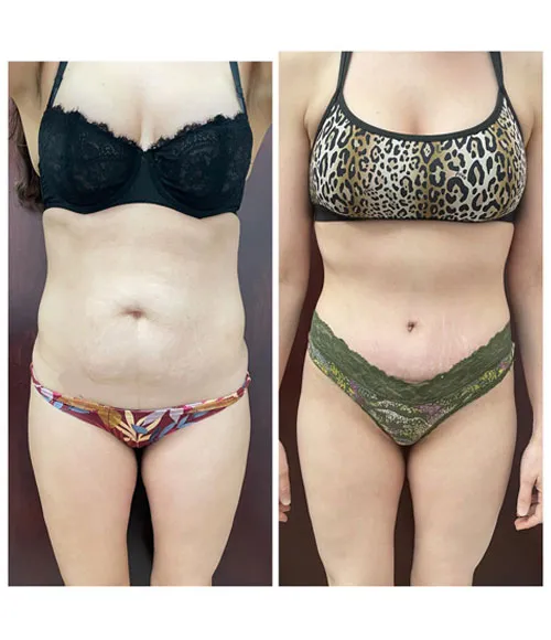 Tummy Tuck (Abdominoplasty) patient result 10