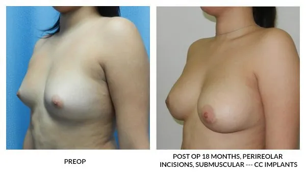 Breast Augmentation patient result 14