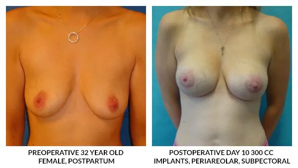 Breast Augmentation patient result 1