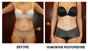 Tummy Tuck (Abdominoplasty) patient result 5