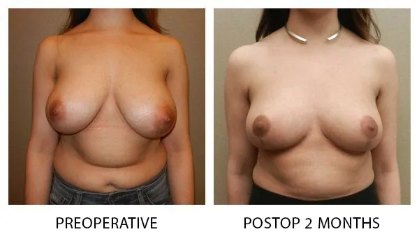 Breast Reduction (Mammoplasty) patient result 16