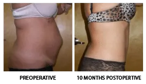 Tummy Tuck (Abdominoplasty) patient result 8