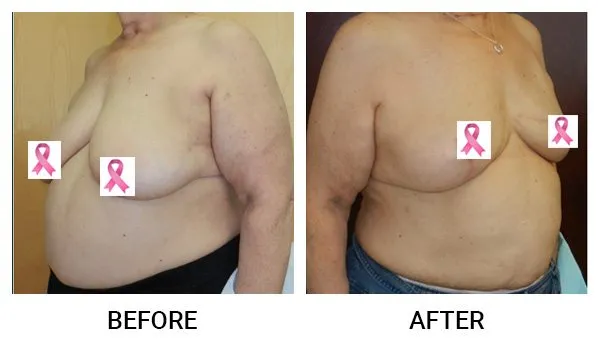 Breast Reconstruction patient result 2