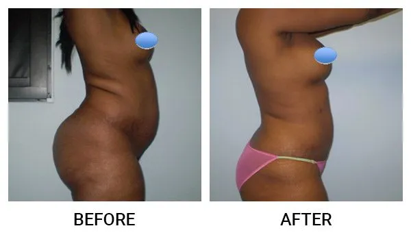 Liposuction patient result 5