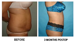 Tummy Tuck (Abdominoplasty) patient result 4