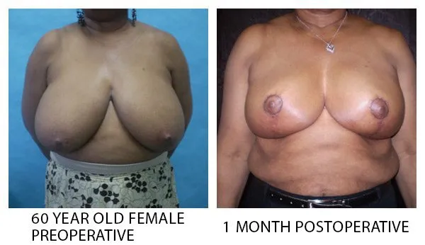 Breast Reduction (Mammoplasty) patient result 20