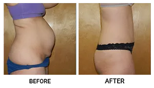 Tummy Tuck (Abdominoplasty) patient result 2