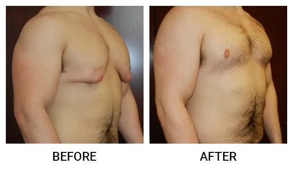 Gynecomastia patient result 4