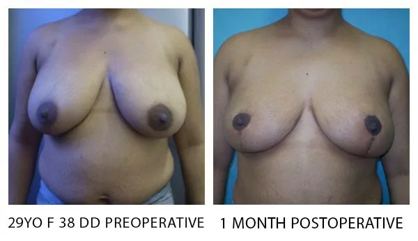 Breast Reduction (Mammoplasty) patient result 13