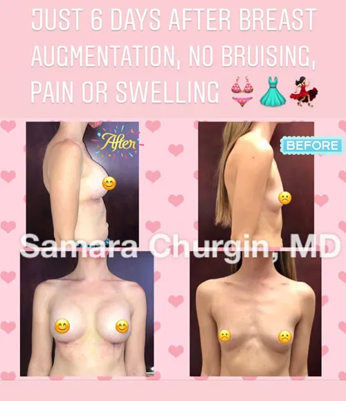 Breast Augmentation patient result 21