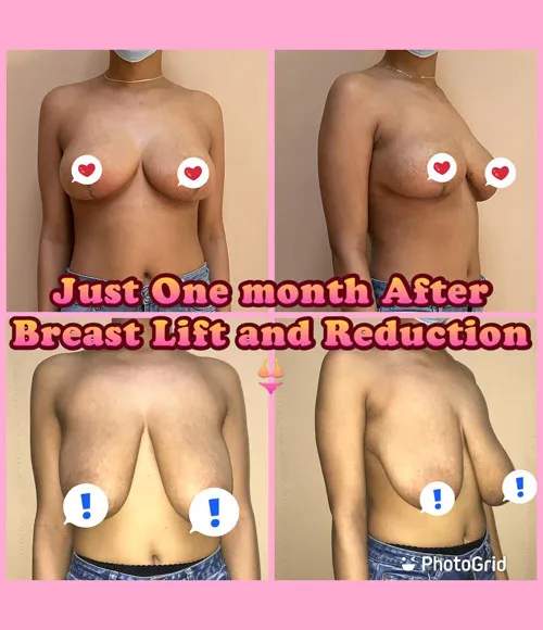 Breast Lift patient result 1