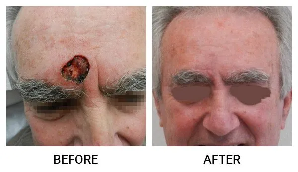 Mohs Reconstruction patient result 7