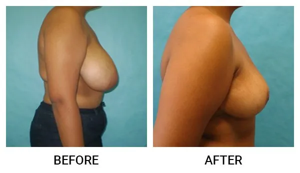 Breast Reduction (Mammoplasty) patient result 3