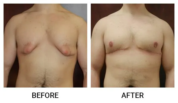 Gynecomastia patient result 3