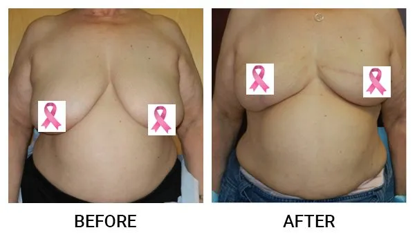 Breast Reconstruction patient result 1