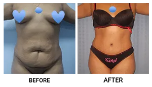 Tummy Tuck (Abdominoplasty) patient result 1