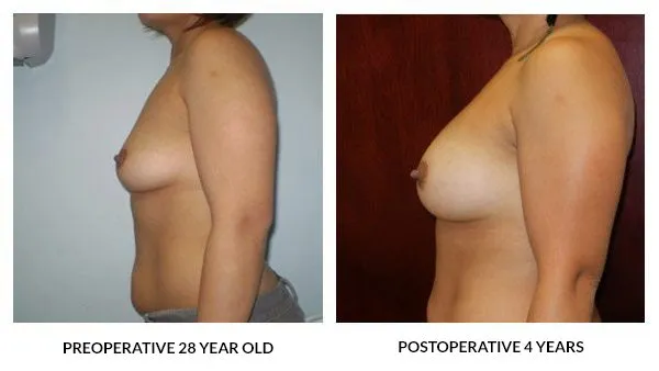Breast Augmentation patient result 8
