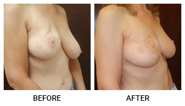 Breast Reconstruction patient result 6